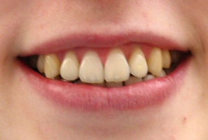 Lingualtechnik - innenliegende Zahnspange