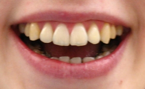 Lingualtechnik - kaum sichtbare Zahnspange