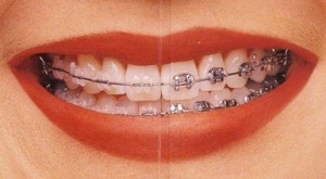 Feste Zahnspange - Vergleich von Keramik und Metall